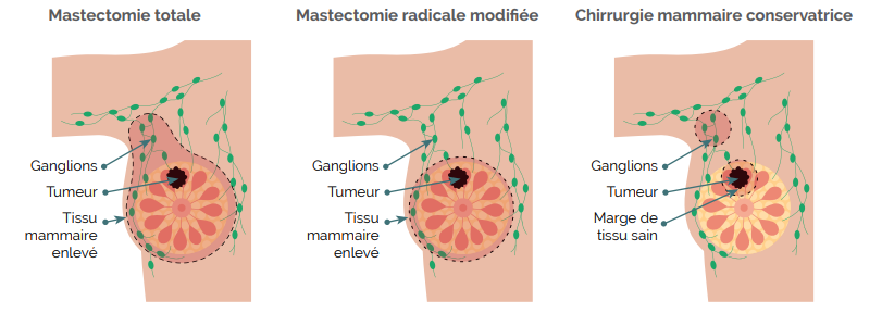 L’intervention chirurgicale, cancer du sein